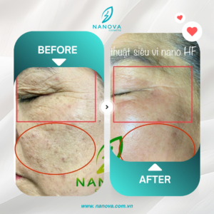 PHỤC HỒI DA NÁM