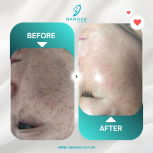 PHỤC HỒI DA NÁM