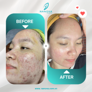 PHỤC HỒI DA MỤN​