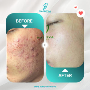 PHỤC HỒI DA MỤN​