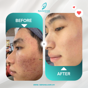 PHỤC HỒI DA MỤN​