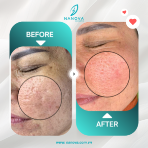 PHỤC HỒI SẸO RỖ