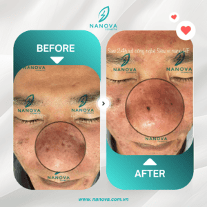 PHỤC HỒI SẸO RỖ